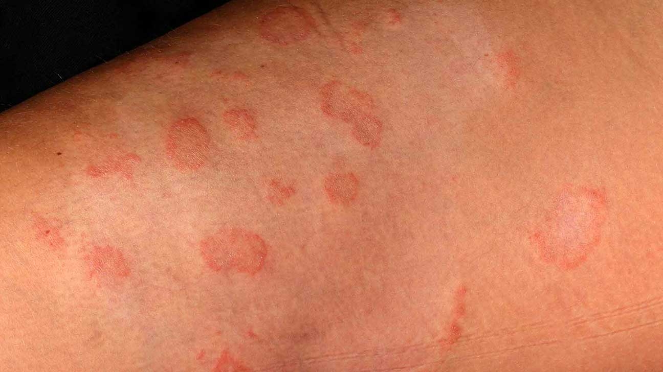 FUNGAL DISEASES IN SKIN