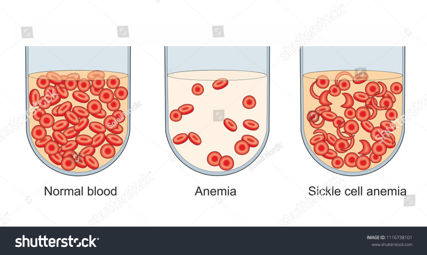 ANEMIA