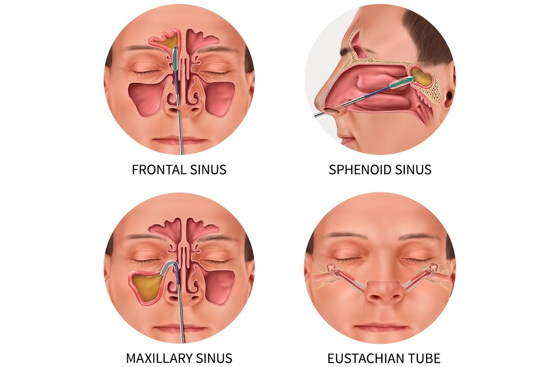 SINUSITIS