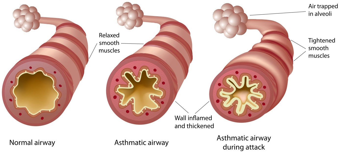 ASTHUMA